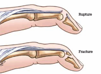 Figure 8. Mallet finger deformity
Reproduced with permission: Brukner P, Khan K. Clinical
Sports Medicine. 3rd edn. Mc-Graw Hill, 2006